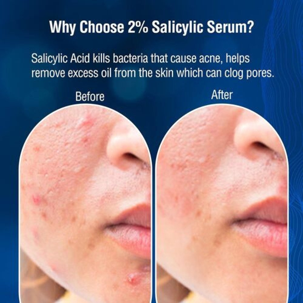 DERMDOC  for Clear Skin | 2% Salicylic Acid Face Serum (15 ml) oily skin  blackheads, whiteheads acne prone skin-15ml Pack Of-2