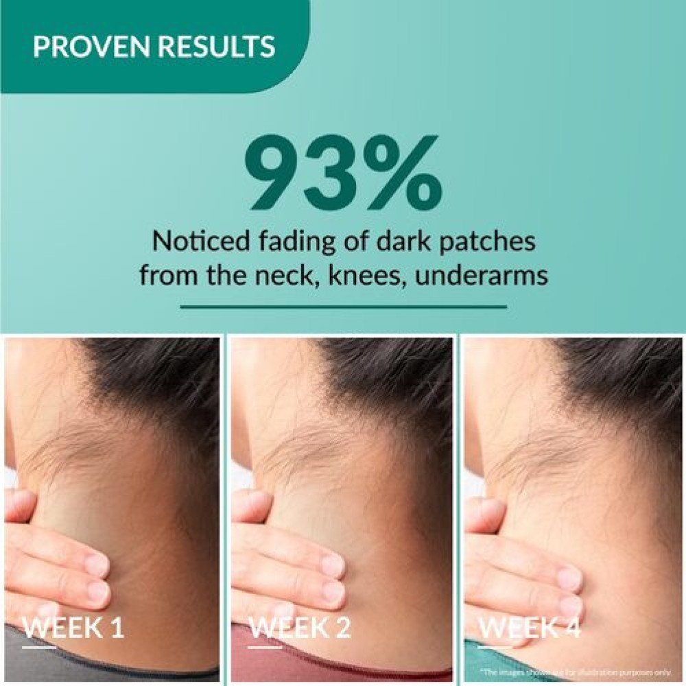 Fixderma Nigrifix Cream for Acanthosis Nigricans with Lactic Acid | Dermatologist Tested Retinol Cream | For Dark Body Parts like Neck, Ankles, Knuckles, Armpits, Thighs & Elbows-50 Gm