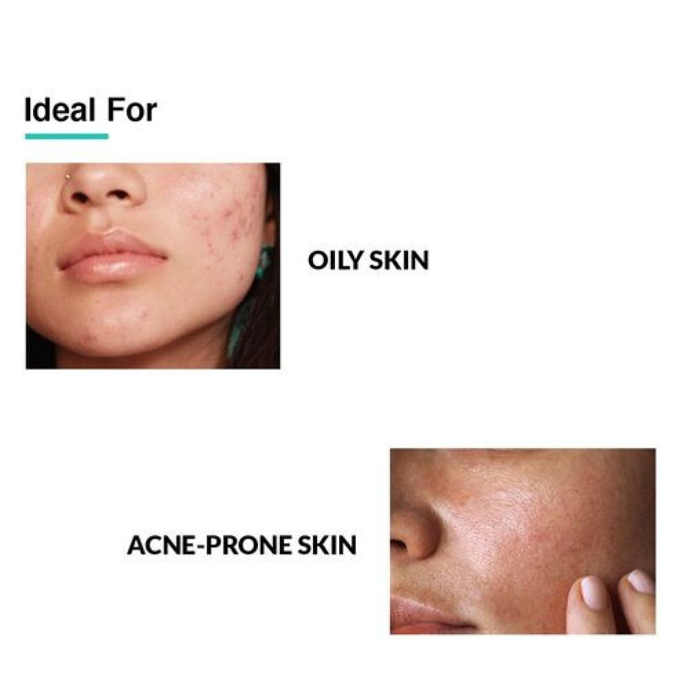 Fixderma 2% Salicylic Acid Serum for Anti Acne & Spot Treatment with 5% Azelaic Acid & 4% Mandelic Acid | Anti Acne Face Serum | Face Serum for Men & Women for Oily Skin - 30Gm